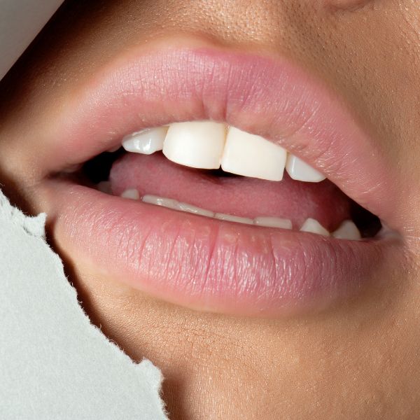 Tratamiento para corregir la sonrisa gingival y reducir la exposición de encía al sonreír, logrando una sonrisa más estética y equilibrada.