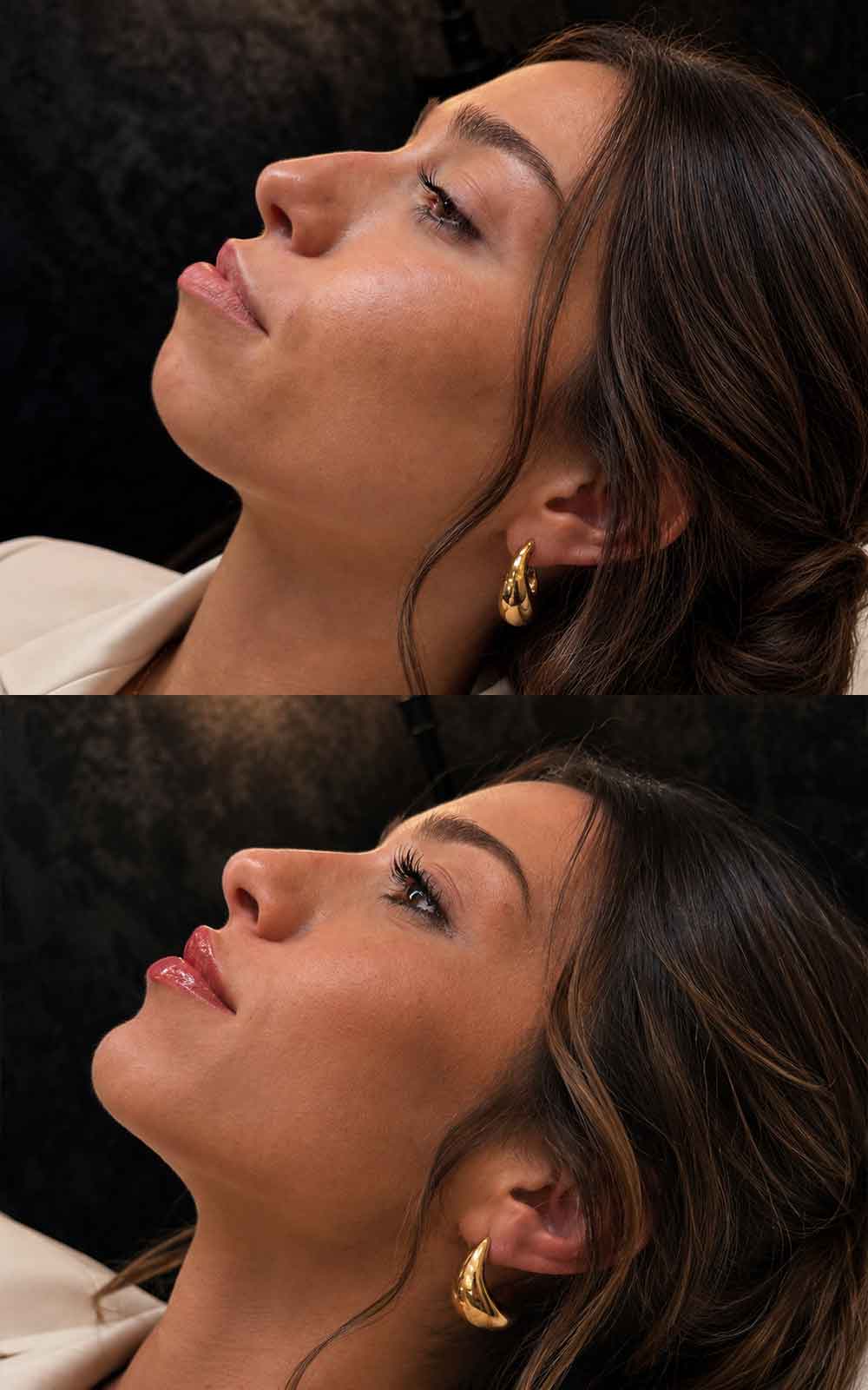 Armonización facial