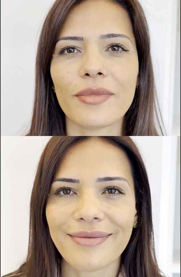 Botox