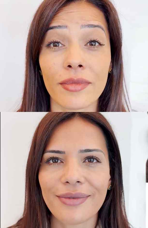 Botox
