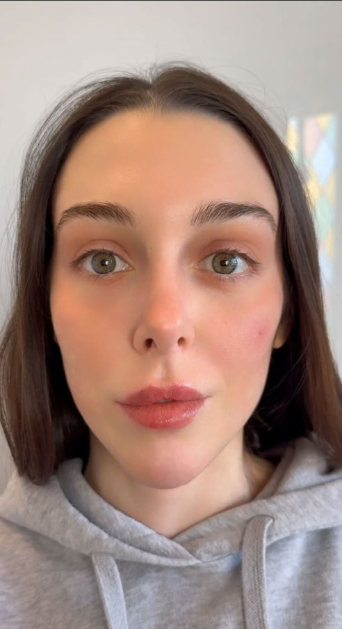 Botox